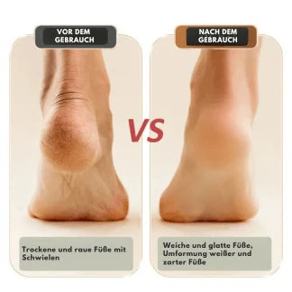 Electric Foot Care Roller with USB Battery